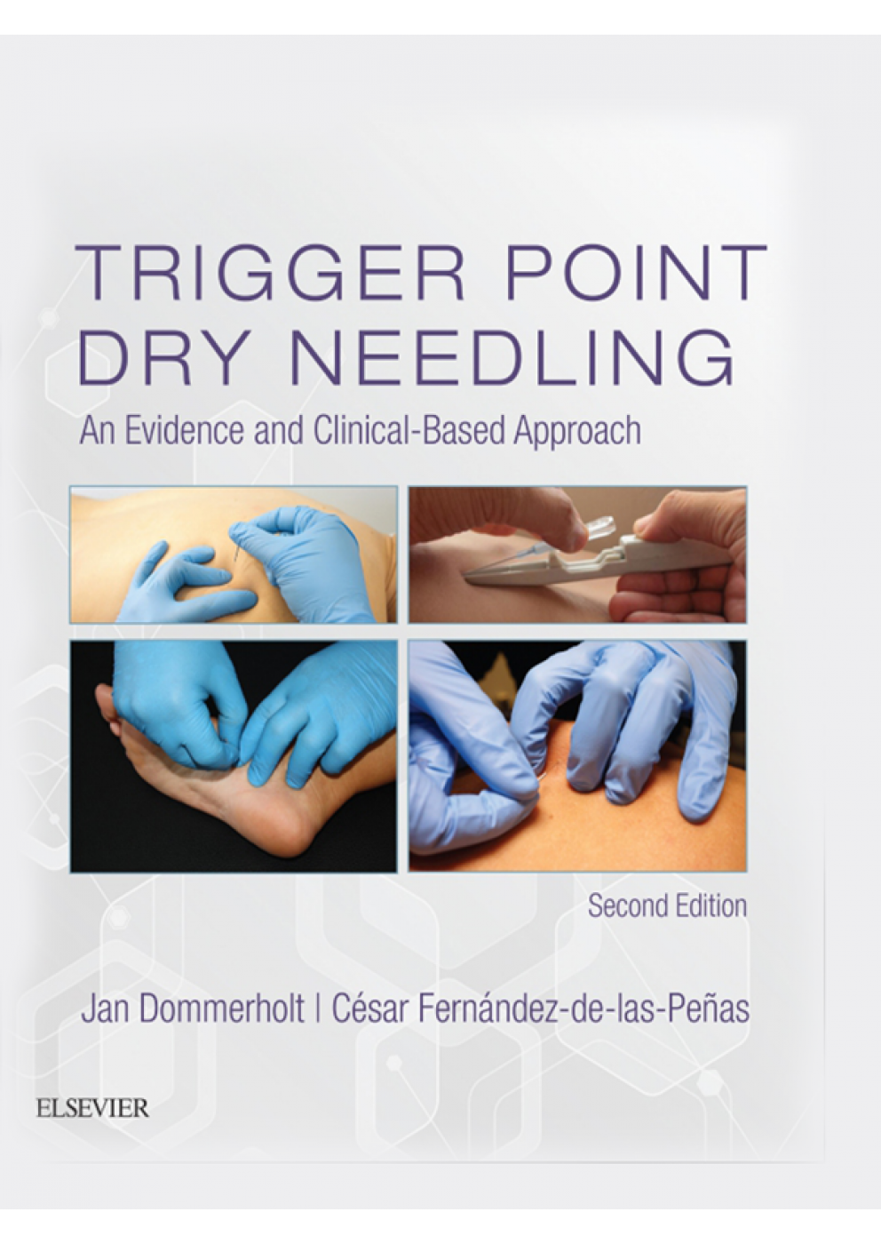 Trigger Point Dry Needling